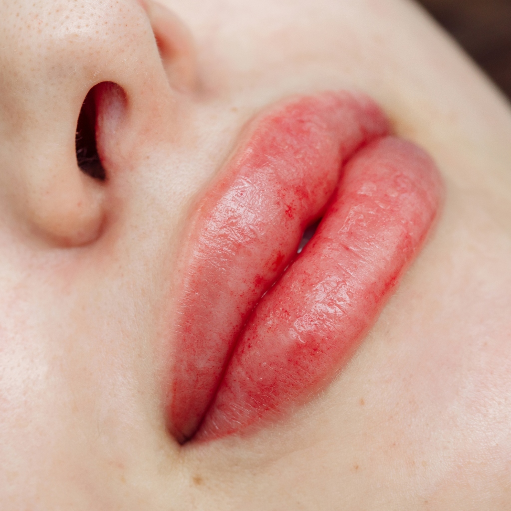 Procedimento de Spa Lips com lábios hidratados.